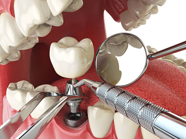 Best Emergency Tooth Extraction in Desert Hot Springs, CA